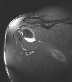 Musculus teres major MRI felvétel 1