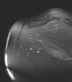 Musculus teres major MRI felvétel 3