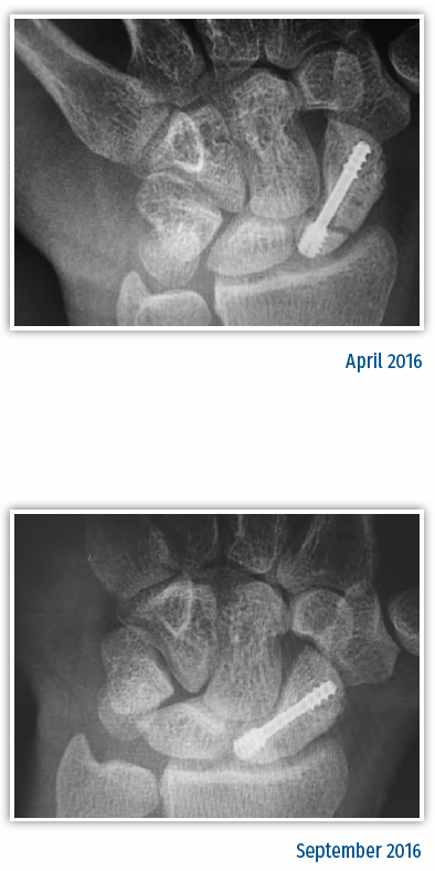 Sajkacsont pszeudoarthrosis - előtte és utána röntgenfelvételek